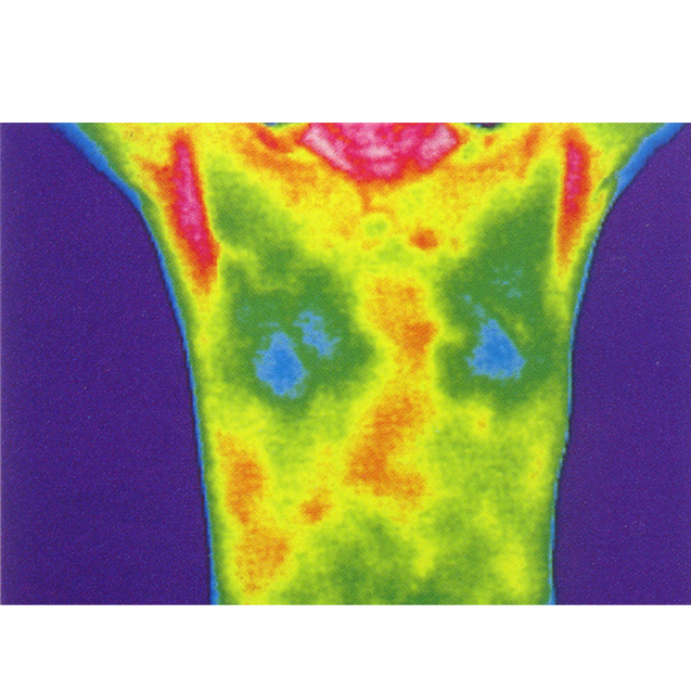   乳腺诊断

热成像可以用来检测乳房组织的温度差异，由于肿瘤组织的新陈代谢通常高于正常组织，它们可能会在热图像上表现为热斑。