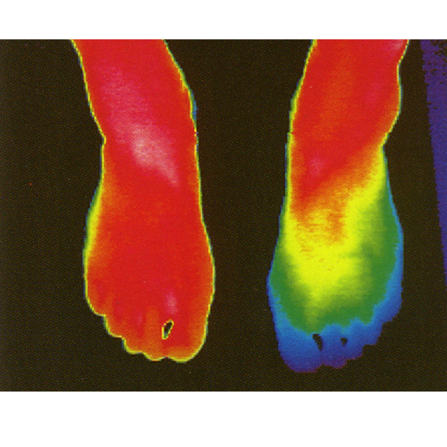   足部健康评估：

热成像可以用来监测糖尿病患者的足部温度，预防足部并发症，如溃疡和感染。