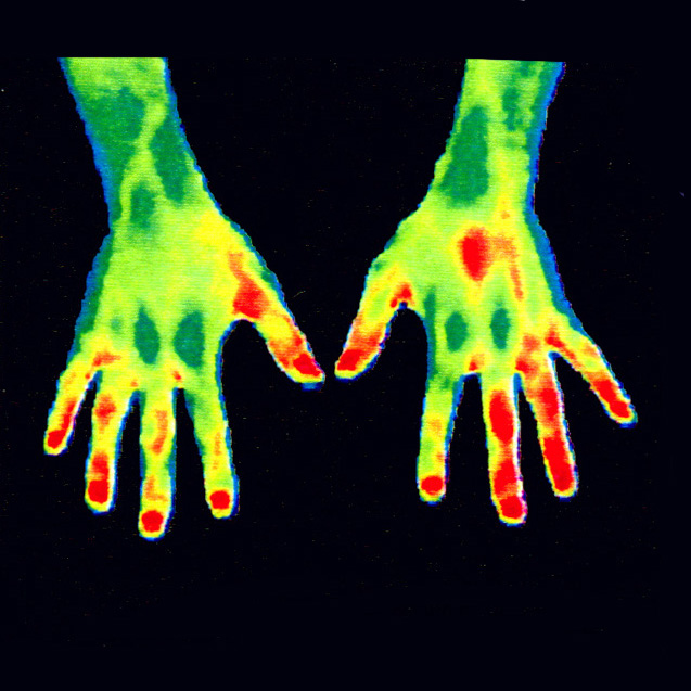   疼痛管理与康复评估：

热成像用于监测肌肉骨骼系统的健康状况，如关节炎患者的关节热力学变化、肌肉拉伤或损伤后愈合过程中的血流恢复情况等。